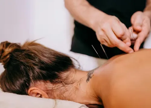 Acupuncture for Weight Loss: Does It Work?